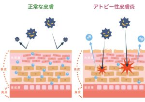 アトピー性皮膚炎とは